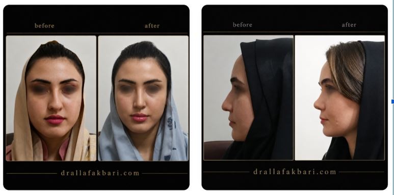 جراحی آندوسکوپی بینی و سینوس؛ درمان قطعی مشکلات تنفسی نمونه جراحی بینی توسط دکتر علاف اکبری